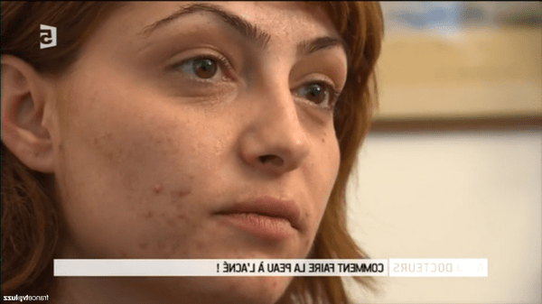 produit acné qui marche