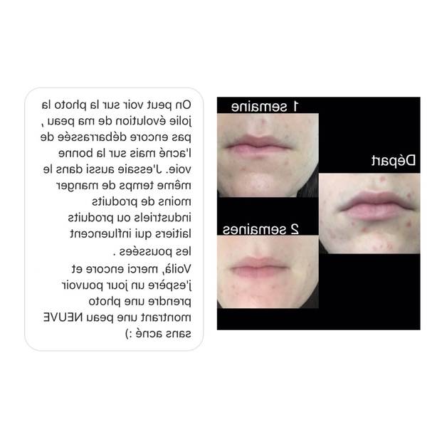 comment traiter acne