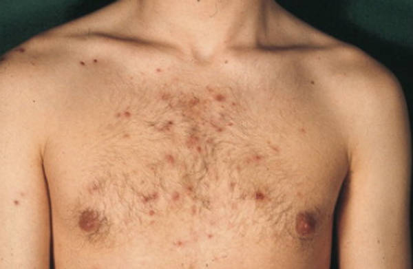 dentifrice bouton acné combien de temps