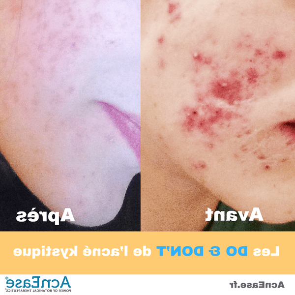 acné grossesse quand