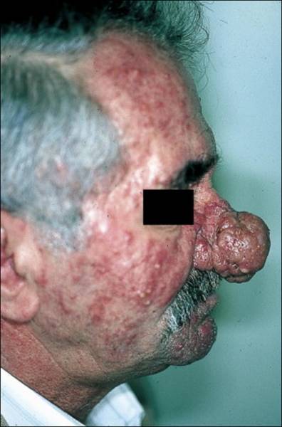 comment enlever boutons acné comment enlever boutons acné